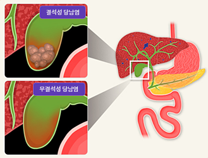 담낭질환