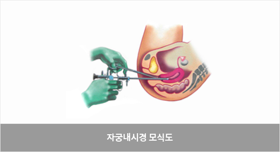 임신성당뇨