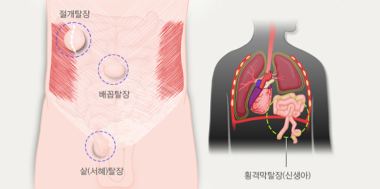 탈장